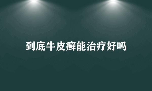 到底牛皮癣能治疗好吗