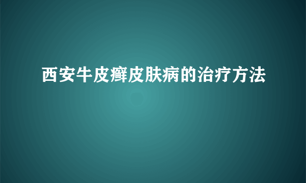 西安牛皮癣皮肤病的治疗方法