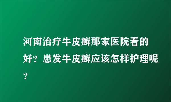 河南治疗牛皮癣那家医院看的好？患发牛皮癣应该怎样护理呢？