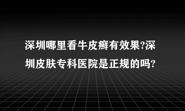 深圳哪里看牛皮癣有效果?深圳皮肤专科医院是正规的吗?