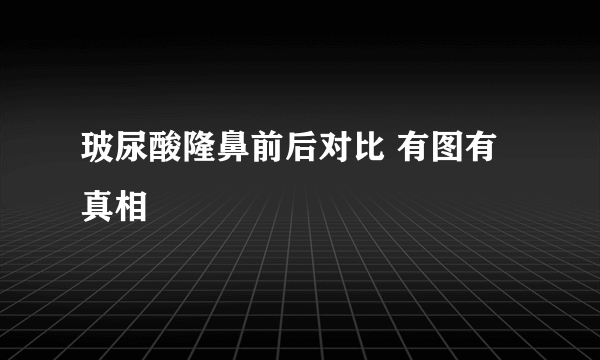 玻尿酸隆鼻前后对比 有图有真相