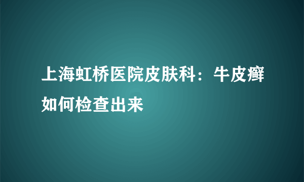 上海虹桥医院皮肤科：牛皮癣如何检查出来