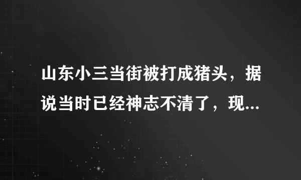 山东小三当街被打成猪头，据说当时已经神志不清了，现在好了吗？