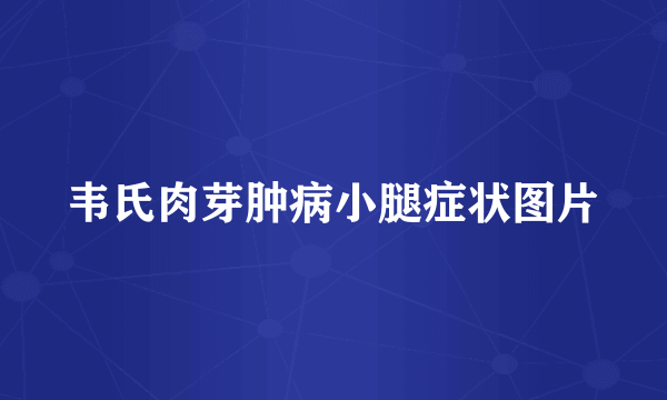 韦氏肉芽肿病小腿症状图片